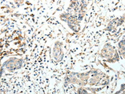 The image on the left is immunohistochemistry of paraffin-embedded Human cervical cancer tissue using CSB-PA188693(FZD3 Antibody) at dilution 1/20, on the right is treated with synthetic peptide. (Original magnification: ×200)