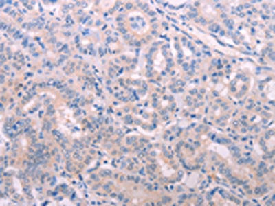The image on the left is immunohistochemistry of paraffin-embedded Human thyroid cancer tissue using CSB-PA188746(TIMP4 Antibody) at dilution 1/15, on the right is treated with fusion protein. (Original magnification: ×200)
