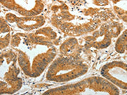 The image on the left is immunohistochemistry of paraffin-embedded Human colon cancer tissue using CSB-PA188838(AKR1C1 Antibody) at dilution 1/30, on the right is treated with synthetic peptide. (Original magnification: ×200)