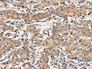 The image on the left is immunohistochemistry of paraffin-embedded Human liver cancer tissue using CSB-PA188909(PPP1CC Antibody) at dilution 1/40, on the right is treated with synthetic peptide. (Original magnification: ×200)