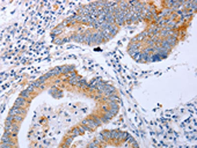The image on the left is immunohistochemistry of paraffin-embedded Human colon cancer tissue using CSB-PA189054(DNMT3L Antibody) at dilution 1/10, on the right is treated with fusion protein. (Original magnification: ×200)