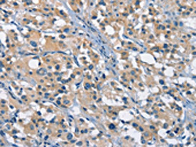 The image on the left is immunohistochemistry of paraffin-embedded Human thyroid cancer tissue using CSB-PA189397(GAS2 Antibody) at dilution 1/50, on the right is treated with fusion protein. (Original magnification: ×200)
