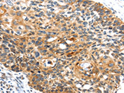 The image on the left is immunohistochemistry of paraffin-embedded Human esophagus cancer tissue using CSB-PA189699(CENPM Antibody) at dilution 1/30, on the right is treated with fusion protein. (Original magnification: ×200)
