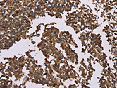The image on the left is immunohistochemistry of paraffin-embedded Human tonsil tissue using CSB-PA189809(OTC Antibody) at dilution 1/50, on the right is treated with fusion protein. (Original magnification: ×200)