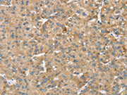 The image on the left is immunohistochemistry of paraffin-embedded Human liver cancer tissue using CSB-PA189826(SMC4 Antibody) at dilution 1/40, on the right is treated with synthetic peptide. (Original magnification: ×200)