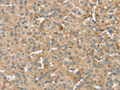 The image on the left is immunohistochemistry of paraffin-embedded Human liver cancer tissue using CSB-PA189826(SMC4 Antibody) at dilution 1/40, on the right is treated with synthetic peptide. (Original magnification: ×200)