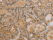The image on the left is immunohistochemistry of paraffin-embedded Human thyroid cancer tissue using CSB-PA189944(IPO9 Antibody) at dilution 1/40, on the right is treated with synthetic peptide. (Original magnification: ×200)