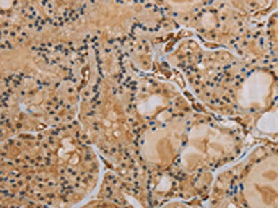 The image on the left is immunohistochemistry of paraffin-embedded Human thyroid cancer tissue using CSB-PA189944(IPO9 Antibody) at dilution 1/40, on the right is treated with synthetic peptide. (Original magnification: ×200)