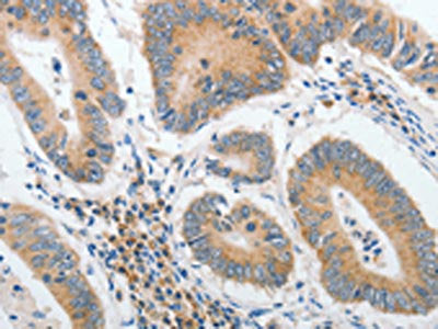 The image on the left is immunohistochemistry of paraffin-embedded Human colon cancer tissue using CSB-PA190095(PIWIL2 Antibody) at dilution 1/40, on the right is treated with synthetic peptide. (Original magnification: ×200)
