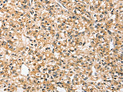 The image on the left is immunohistochemistry of paraffin-embedded Human prostate cancer tissue using CSB-PA190316(SLC44A2 Antibody) at dilution 1/20, on the right is treated with synthetic peptide. (Original magnification: ×200)