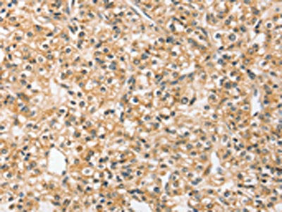The image on the left is immunohistochemistry of paraffin-embedded Human prostate cancer tissue using CSB-PA190316(SLC44A2 Antibody) at dilution 1/20, on the right is treated with synthetic peptide. (Original magnification: ×200)