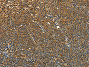 The image on the left is immunohistochemistry of paraffin-embedded Human lymphoma tissue using CSB-PA190435(TEKT1 Antibody) at dilution 1/30, on the right is treated with fusion protein. (Original magnification: ×200)