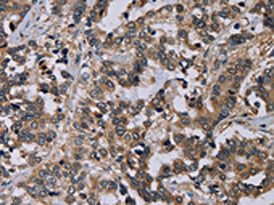 The image on the left is immunohistochemistry of paraffin-embedded Human liver cancer tissue using CSB-PA190585(PVRL4 Antibody) at dilution 1/60, on the right is treated with fusion protein. (Original magnification: ×200)