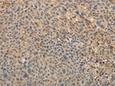 The image on the left is immunohistochemistry of paraffin-embedded Human liver cancer tissue using CSB-PA190654(OCLN Antibody) at dilution 1/10, on the right is treated with fusion protein. (Original magnification: x200)