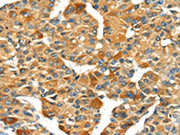 The image on the left is immunohistochemistry of paraffin-embedded Human liver cancer tissue using CSB-PA190682(SPARC Antibody) at dilution 1/35, on the right is treated with fusion protein. (Original magnification: ×200)