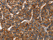 The image on the left is immunohistochemistry of paraffin-embedded Human liver cancer tissue using CSB-PA191134(CACNB2 Antibody) at dilution 1/30, on the right is treated with synthetic peptide. (Original magnification: ×200)
