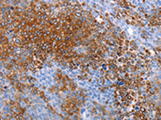 The image on the left is immunohistochemistry of paraffin-embedded Human ovarian cancer tissue using CSB-PA191314(AQP5 Antibody) at dilution 1/20, on the right is treated with synthetic peptide. (Original magnification: ×200)