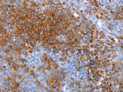 The image on the left is immunohistochemistry of paraffin-embedded Human ovarian cancer tissue using CSB-PA191314(AQP5 Antibody) at dilution 1/20, on the right is treated with synthetic peptide. (Original magnification: ×200)