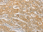 The image on the left is immunohistochemistry of paraffin-embedded Human gastic cancer tissue using CSB-PA191316(PGK2 Antibody) at dilution 1/50, on the right is treated with fusion protein. (Original magnification: ×200)