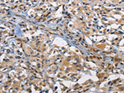 The image on the left is immunohistochemistry of paraffin-embedded Human thyroid cancer tissue using CSB-PA191502(FOS Antibody) at dilution 1/70, on the right is treated with fusion protein. (Original magnification: ×200)