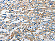 The image on the left is immunohistochemistry of paraffin-embedded Human esophagus cancer tissue using CSB-PA191560(CD44 Antibody) at dilution 1/25, on the right is treated with synthetic peptide. (Original magnification: ×200)