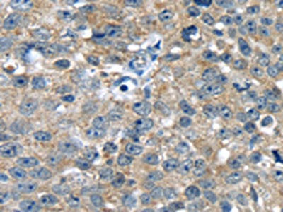 The image on the left is immunohistochemistry of paraffin-embedded Human breast cancer tissue using CSB-PA191657(PBOV1 Antibody) at dilution 1/20, on the right is treated with synthetic peptide. (Original magnification: ×200)