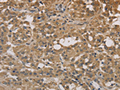 The image on the left is immunohistochemistry of paraffin-embedded Human thyroid cancer tissue using CSB-PA191736(DEGS1 Antibody) at dilution 1/30, on the right is treated with fusion protein. (Original magnification: ×200)