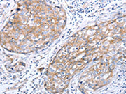 The image on the left is immunohistochemistry of paraffin-embedded Human breast cancer tissue using CSB-PA192001(RASSF1 Antibody) at dilution 1/70, on the right is treated with synthetic peptide. (Original magnification: ×200)