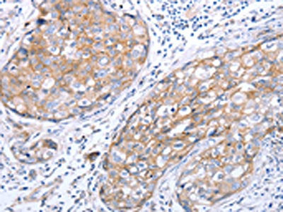 The image on the left is immunohistochemistry of paraffin-embedded Human breast cancer tissue using CSB-PA192001(RASSF1 Antibody) at dilution 1/70, on the right is treated with synthetic peptide. (Original magnification: ×200)