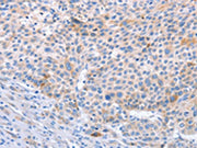 The image on the left is immunohistochemistry of paraffin-embedded Human liver cancer tissue using CSB-PA192084(STK3/STK4 Antibody) at dilution 1/70, on the right is treated with synthetic peptide. (Original magnification: ×200)