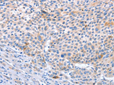The image on the left is immunohistochemistry of paraffin-embedded Human liver cancer tissue using CSB-PA192084(STK3/STK4 Antibody) at dilution 1/70, on the right is treated with synthetic peptide. (Original magnification: ×200)