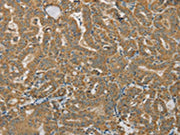 The image on the left is immunohistochemistry of paraffin-embedded Human thyroid cancer tissue using CSB-PA192307(SDHB Antibody) at dilution 1/30, on the right is treated with synthetic peptide. (Original magnification: ×200)