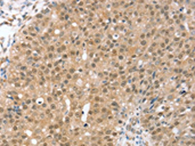 The image on the left is immunohistochemistry of paraffin-embedded Human breast cancer tissue using CSB-PA192313(TRIM35 Antibody) at dilution 1/35, on the right is treated with synthetic peptide. (Original magnification: ×200)