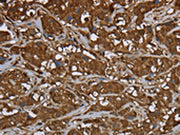 The image on the left is immunohistochemistry of paraffin-embedded Human breast cancer tissue using CSB-PA192321(ARHGDIA Antibody) at dilution 1/50, on the right is treated with fusion protein. (Original magnification: ×200)