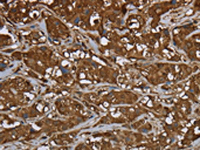 The image on the left is immunohistochemistry of paraffin-embedded Human breast cancer tissue using CSB-PA192321(ARHGDIA Antibody) at dilution 1/50, on the right is treated with fusion protein. (Original magnification: ×200)