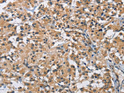 The image on the left is immunohistochemistry of paraffin-embedded Human thyroid cancer tissue using CSB-PA192471(BMP15 Antibody) at dilution 1/40, on the right is treated with fusion protein. (Original magnification: ×200)