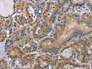 The image on the left is immunohistochemistry of paraffin-embedded Human thyroid cancer tissue using CSB-PA192473(BTG1 Antibody) at dilution 1/15, on the right is treated with fusion protein. (Original magnification: ×200)