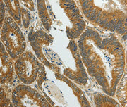 Immunohistochemical analysis of paraffin-embedded Human colon cancer tissue using at dilution 1/70.