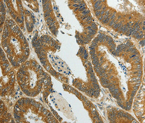 Immunohistochemical analysis of paraffin-embedded Human colon cancer tissue using at dilution 1/70.