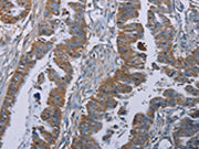 The image on the left is immunohistochemistry of paraffin-embedded Human esophagus cancer tissue using CSB-PA192641(BMP3 Antibody) at dilution 1/30, on the right is treated with synthetic peptide. (Original magnification: ×200)