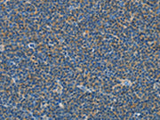 The image on the left is immunohistochemistry of paraffin-embedded Human lymphoma tissue using CSB-PA192719(COX7B2 Antibody) at dilution 1/15, on the right is treated with fusion protein. (Original magnification: ×200)