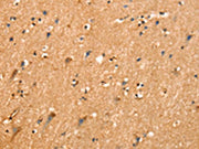 The image on the left is immunohistochemistry of paraffin-embedded Human brain tissue using CSB-PA192747(SLC25A4 Antibody) at dilution 1/25, on the right is treated with synthetic peptide. (Original magnification: ×200)