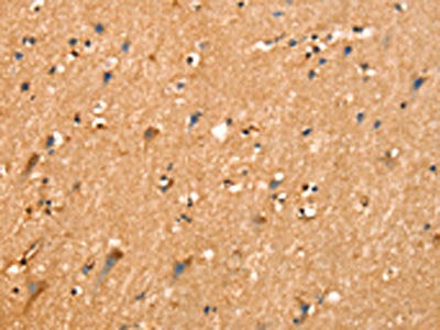 The image on the left is immunohistochemistry of paraffin-embedded Human brain tissue using CSB-PA192747(SLC25A4 Antibody) at dilution 1/25, on the right is treated with synthetic peptide. (Original magnification: ×200)