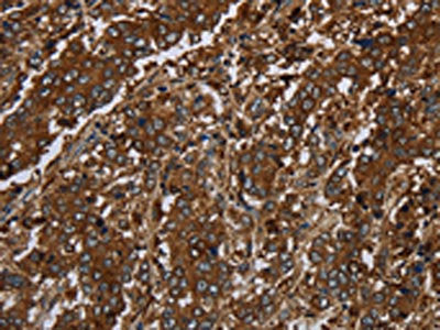 The image on the left is immunohistochemistry of paraffin-embedded Human liver cancer tissue using CSB-PA192826(KLRF1 Antibody) at dilution 1/30, on the right is treated with synthetic peptide. (Original magnification: ×200)