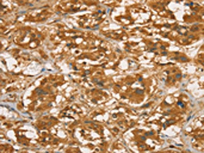 The image on the left is immunohistochemistry of paraffin-embedded Human thyroid cancer tissue using CSB-PA192852(RBBP8 Antibody) at dilution 1/45, on the right is treated with fusion protein. (Original magnification: ×200)