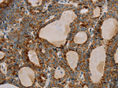 The image on the left is immunohistochemistry of paraffin-embedded Human thyroid cancer tissue using CSB-PA193064(PARL Antibody) at dilution 1/20, on the right is treated with fusion protein. (Original magnification: ×200)
