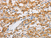 The image on the left is immunohistochemistry of paraffin-embedded Human thyroid cancer tissue using CSB-PA193095(FARSB Antibody) at dilution 1/20, on the right is treated with fusion protein. (Original magnification: ×200)
