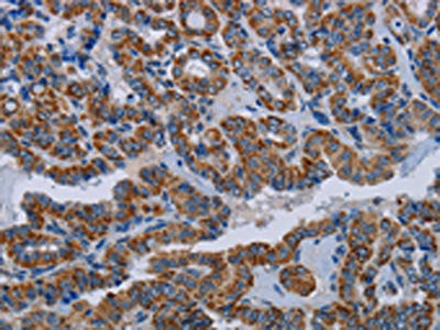 The image on the left is immunohistochemistry of paraffin-embedded Human thyroid cancer tissue using CSB-PA193298(NDUFS8 Antibody) at dilution 1/20, on the right is treated with fusion protein. (Original magnification: ×200)