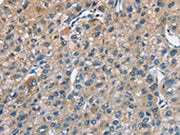 The image on the left is immunohistochemistry of paraffin-embedded Human liver cancer tissue using CSB-PA193346(TRIP4 Antibody) at dilution 1/50, on the right is treated with fusion protein. (Original magnification: ×200)