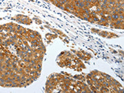 The image on the left is immunohistochemistry of paraffin-embedded Human liver cancer tissue using CSB-PA193383(SLC22A3 Antibody) at dilution 1/25, on the right is treated with synthetic peptide. (Original magnification: ×200)